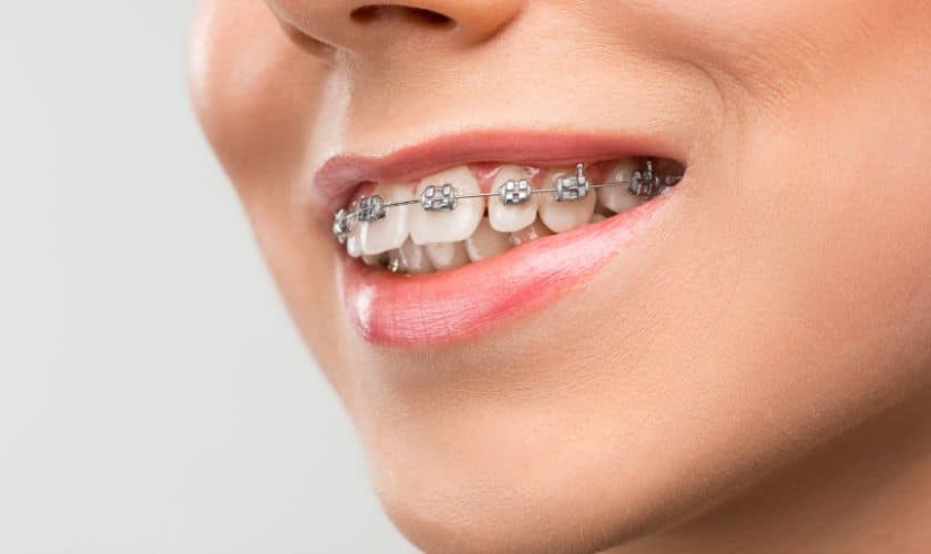 Orthodontic Treatment in West Palm Beach, FL