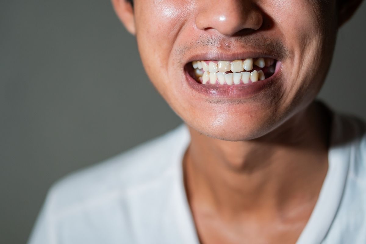 Can Crooked Teeth Cause Gum Disease?